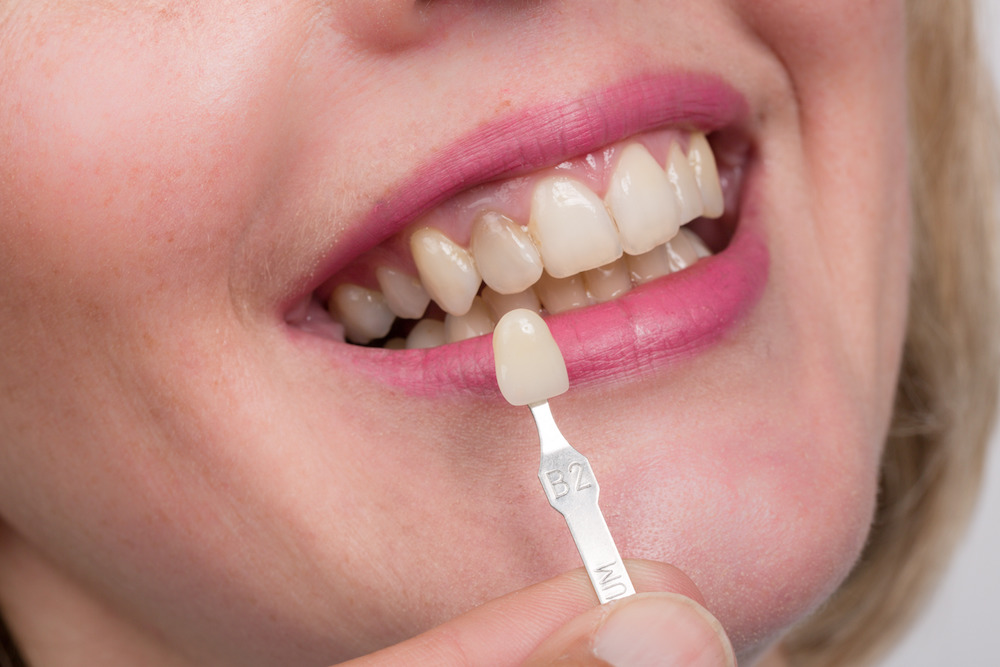 Four Important Things you Should Know about Dental Crowns